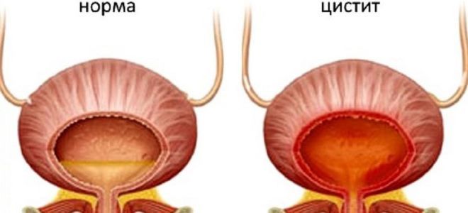цистит причины цистит причины