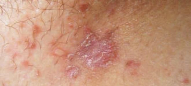 иппп что это такое иппп что это такое