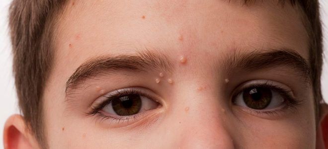 Как выглядит контагиозный моллюск раз Как выглядит контагиозный моллюск раз