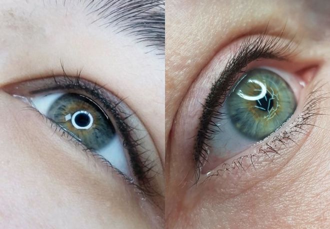 как выглядит межресничка как выглядит межресничка