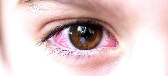 конъюнктивит причины конъюнктивит причины