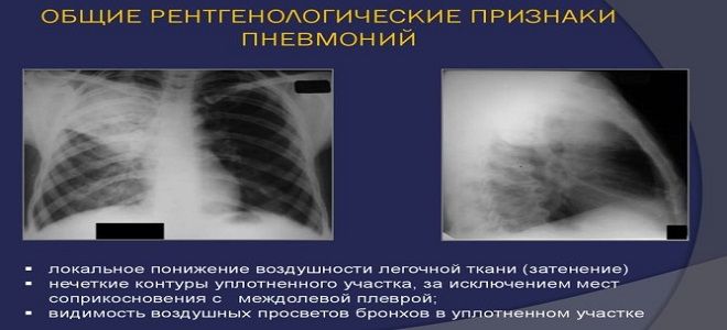 лечение при полисегментарной пневмонии лечение при полисегментарной пневмонии