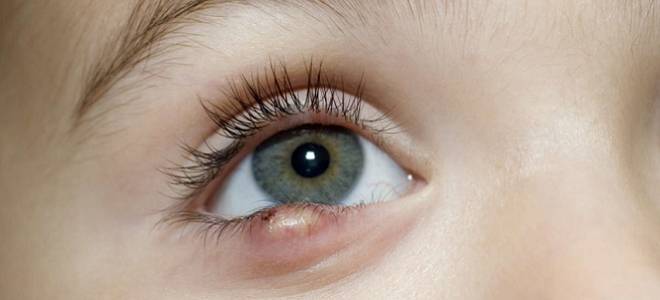 лекарство от ячменя на глазу лекарство от ячменя на глазу