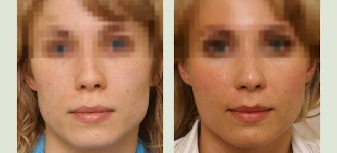 липофилинг показания липофилинг показания