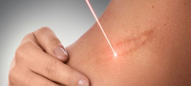 Можно ли избавиться от шрама Можно ли избавиться от шрама