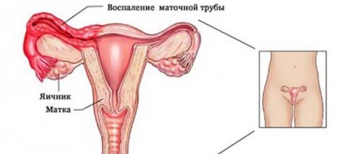 острый аднексит острый аднексит
