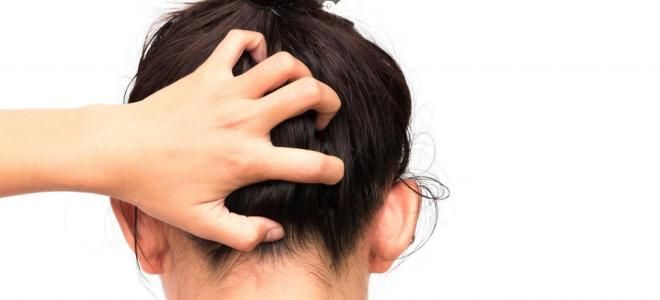 Псориаз на голове симптомы Псориаз на голове симптомы