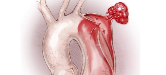 разрыв аорты причины разрыв аорты причины