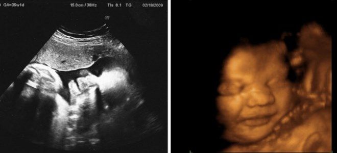 роды в 35 недель роды в 35 недель