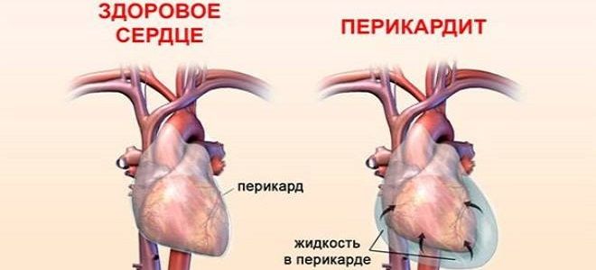 синдром дресслера проявляется синдром дресслера проявляется