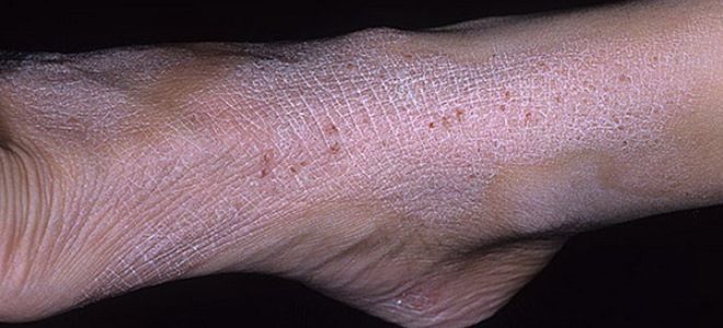 сухая экзема на теле сухая экзема на теле