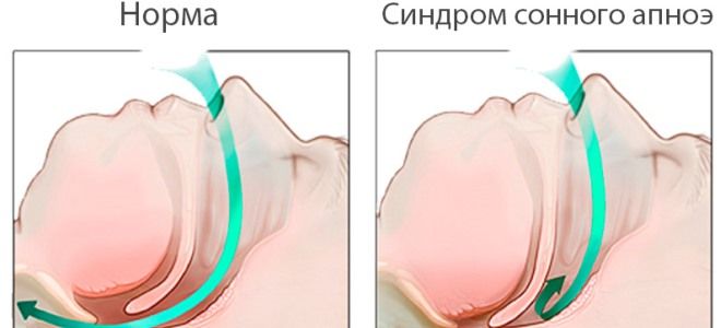 виды апноэ и механизмы их развития виды апноэ и механизмы их развития