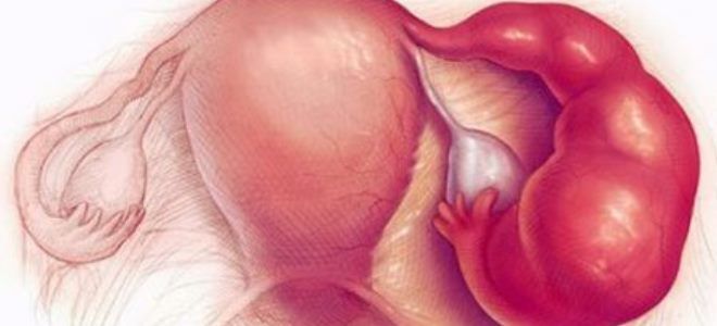 аднексит симптомы аднексит симптомы