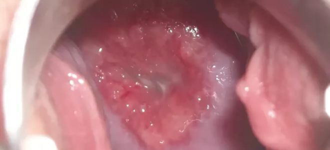 атрофический цервицит атрофический цервицит