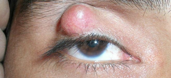 чем опасен ячмень на глазу чем опасен ячмень на глазу