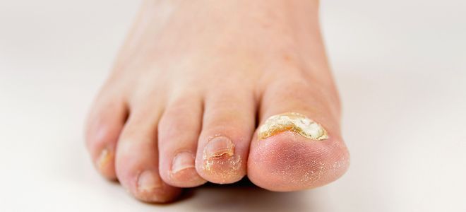 грибковые заболевания грибковые заболевания