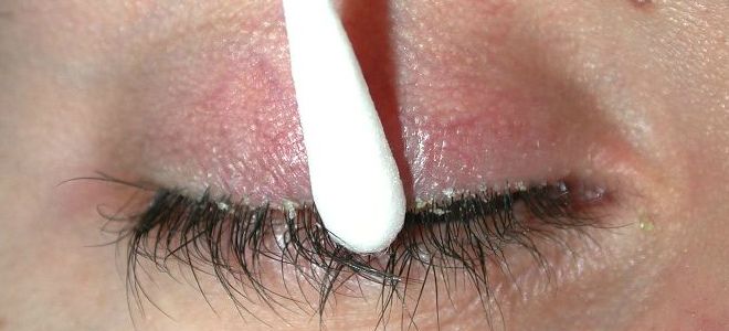 ихтиоловая мазь офтальмологии ихтиоловая мазь офтальмологии