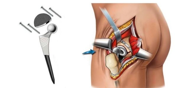 Как проводится операция по замене тазобедренного сустава Как проводится операция по замене тазобедренного сустава