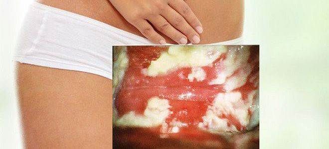 кандидерм от чего кандидерм от чего