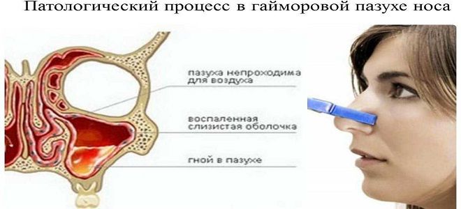 капли для лечения синусита капли для лечения синусита