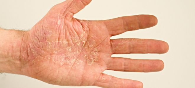 корковая экзема корковая экзема