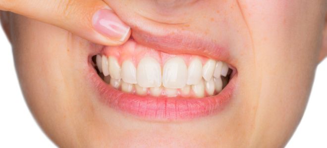 Метилурациловая мазь в стоматологии Метилурациловая мазь в стоматологии