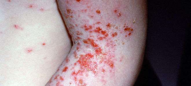 первые симптомы чесотки у детей первые симптомы чесотки у детей