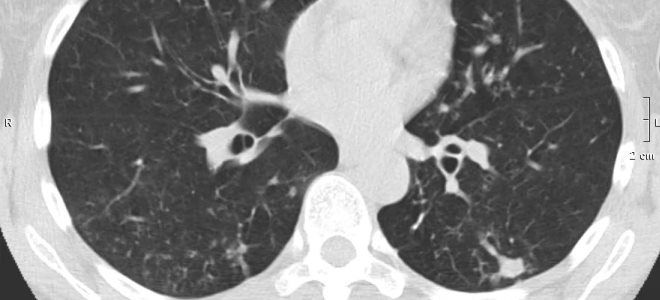 почечная аплазия почечная аплазия