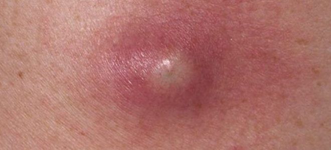 причины сифилиса причины сифилиса