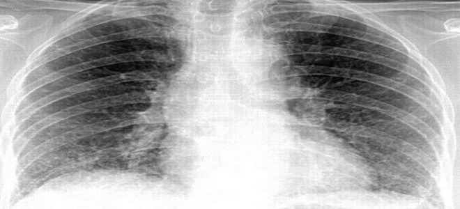 признаки полисегментарной пневмонии признаки полисегментарной пневмонии