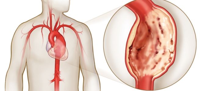 признаки расслоения аорты признаки расслоения аорты