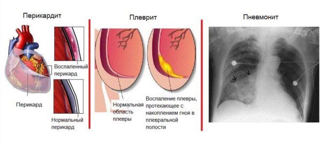 проявления синдрома дресслера проявления синдрома дресслера