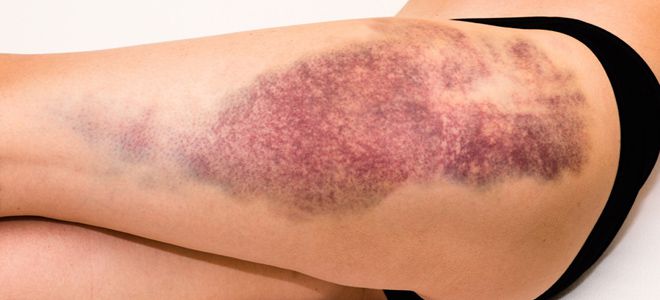 сами по себе появляются синяки на ногах сами по себе появляются синяки на ногах