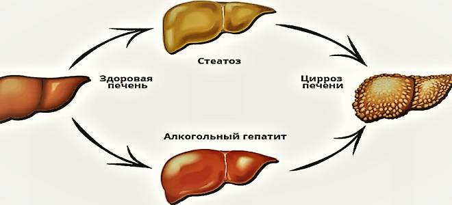 фото2 симптомы заболевания печени