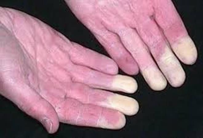 синдром белых пальцев синдром белых пальцев