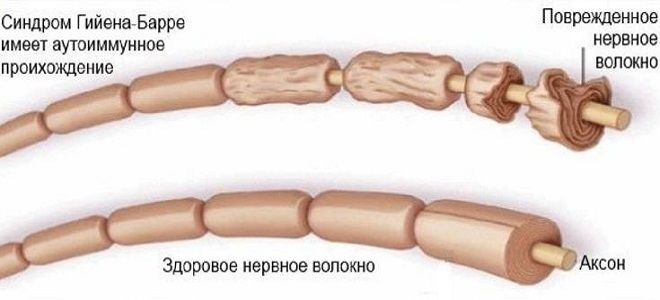 синдром гийена барре анализы синдром гийена барре анализы