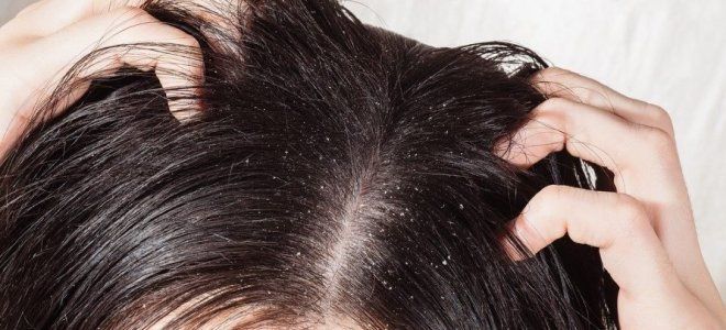 Стадии псориаза головы ранняя Стадии псориаза головы ранняя