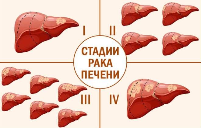стадии рака печени стадии рака печени