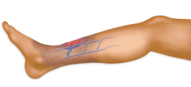 трофическая язва симптомы трофическая язва симптомы