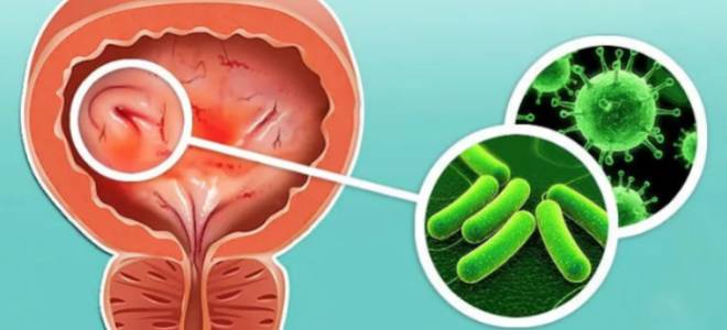 виды цистита виды цистита