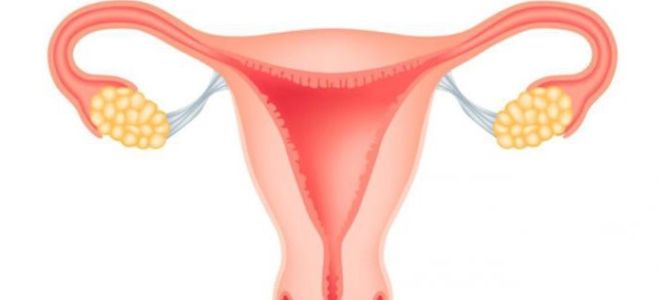 воспаление придатков воспаление придатков