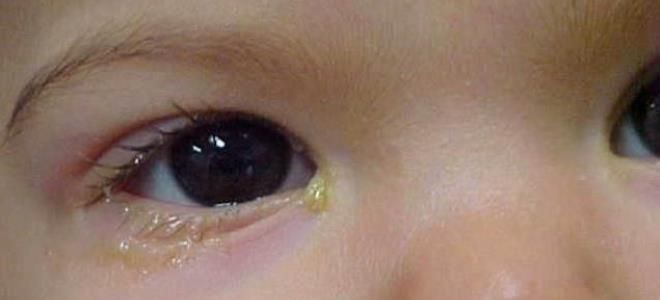 воспаление слизистой глаз воспаление слизистой глаз