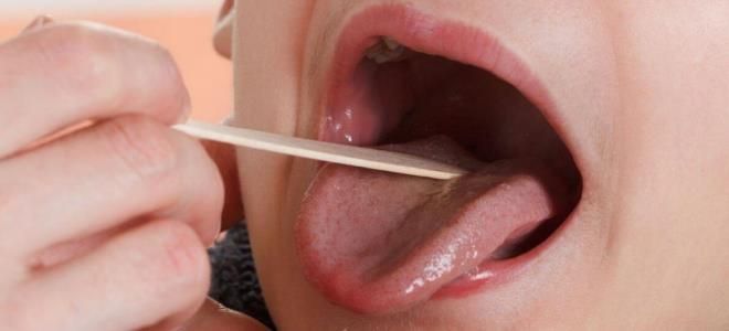 чем лечить тонзиллит чем лечить тонзиллит