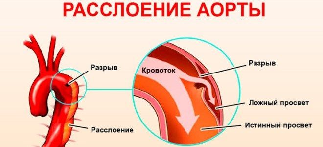 что такое аневризма сосудов что такое аневризма сосудов
