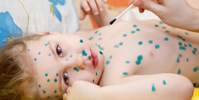 инфекционная ветрянка инфекционная ветрянка