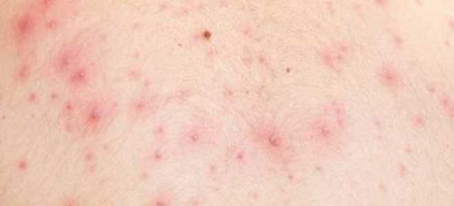 кандидозы у женщин кандидозы у женщин