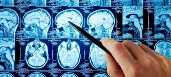 киста пинеальной железы киста пинеальной железы