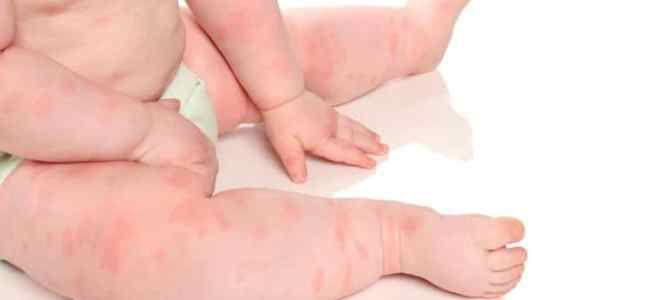 мазь декспантенол при дерматите мазь декспантенол при дерматите