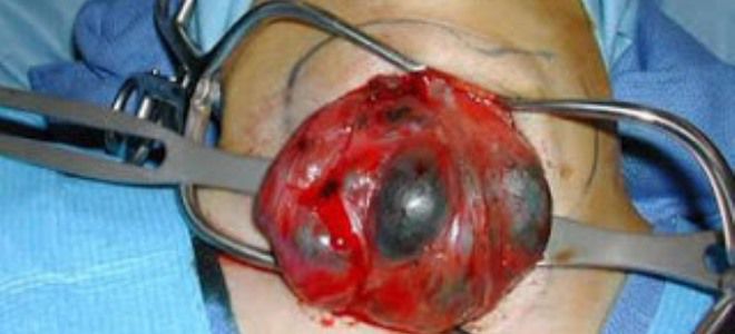 операция папиллярная карцинома операция папиллярная карцинома