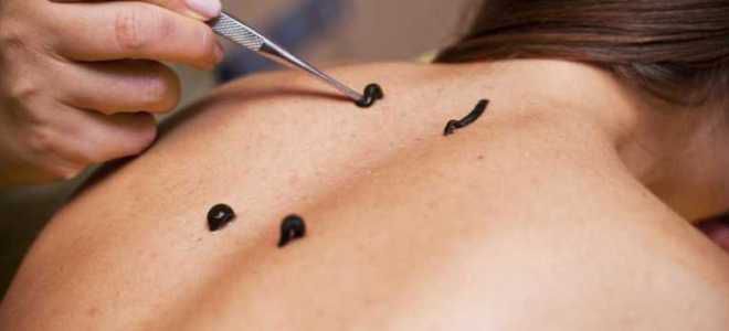 пиявки от остеохондроза пиявки от остеохондроза